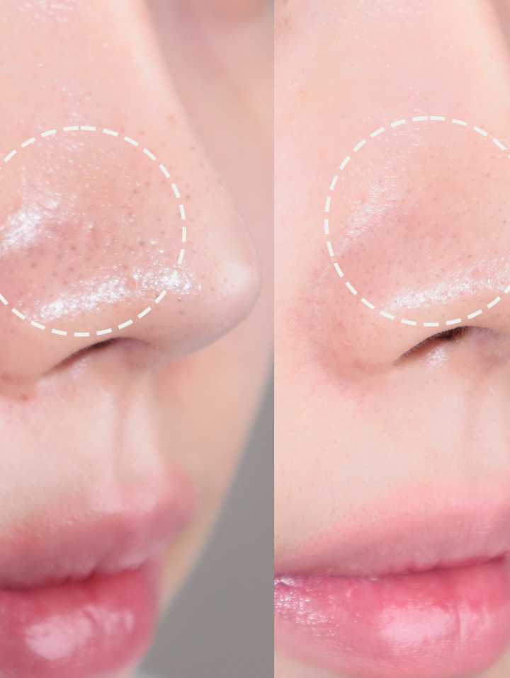 Bye Blackhead Melting Remover (Qara Nöqtə və Məsamə Təmizləyici)